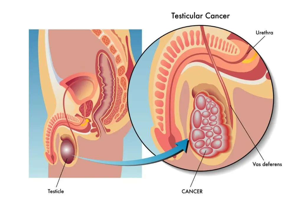 cancer de testiculo sintomas diagnostico tratamento 1024x683 1